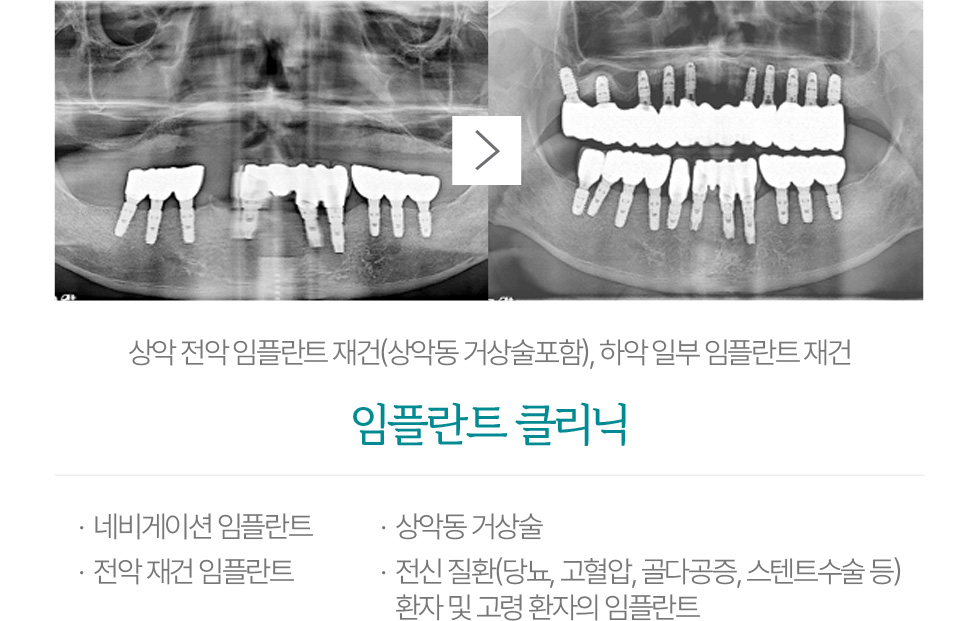 임플란트 클리닉