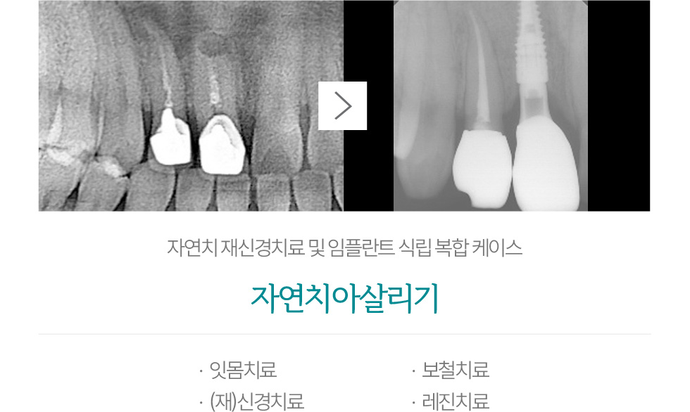 자연치아살리기