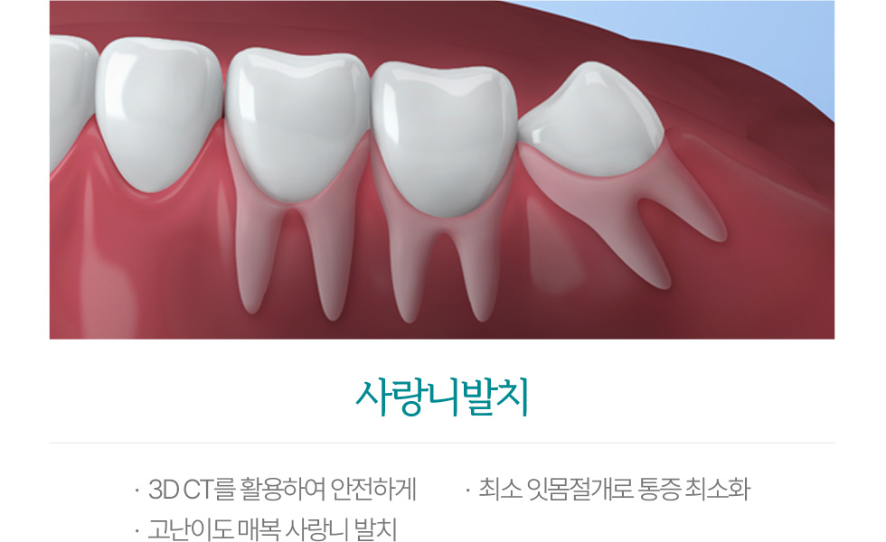 사랑니발치