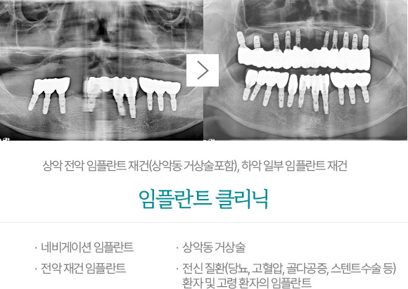 임플란트 클리닉