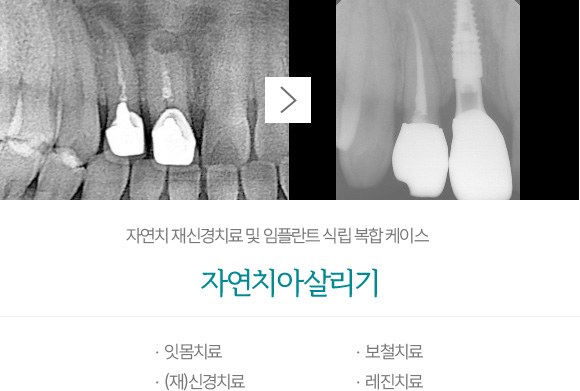 자연치아살리기