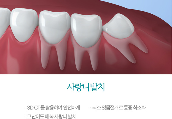 사랑니발치